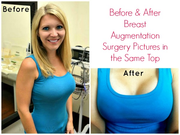 augmentation post breast op pics