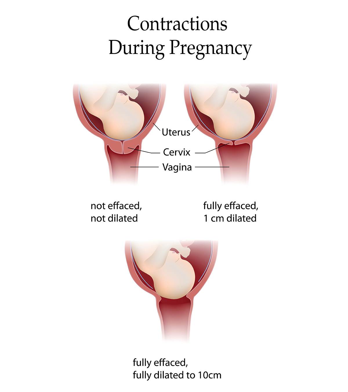 pain vagina pregnancy in