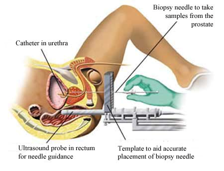prostate biopsy to