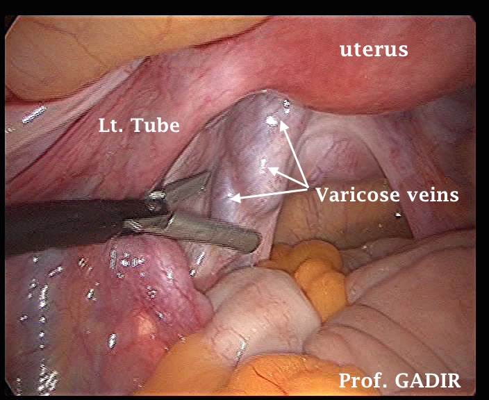 veins in vagina
