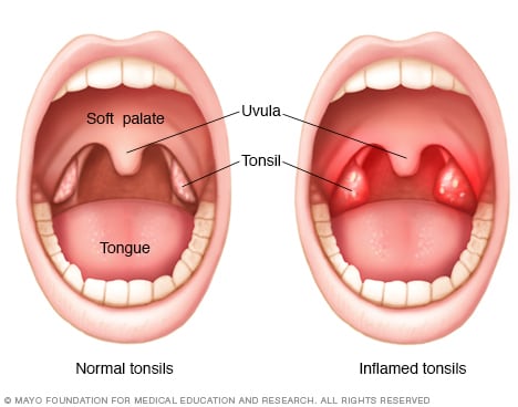 tonsil adult picture swollen
