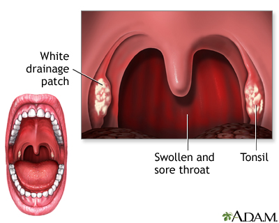 tonsil adult picture swollen