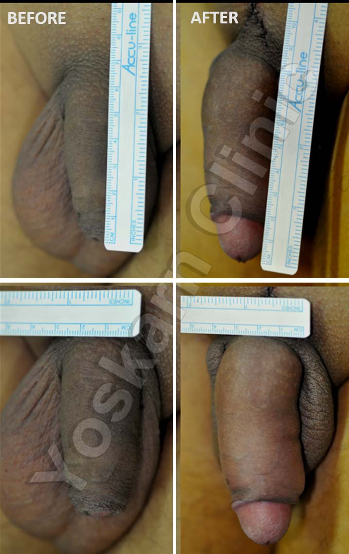 photos after erect penis surgery
