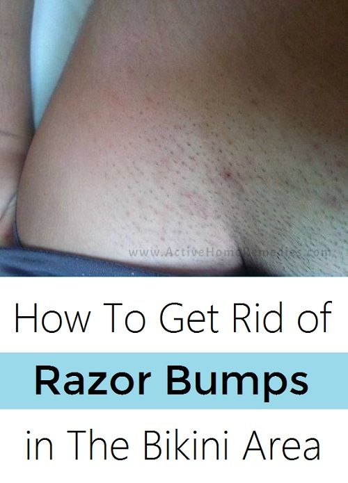bikini area razor bumps