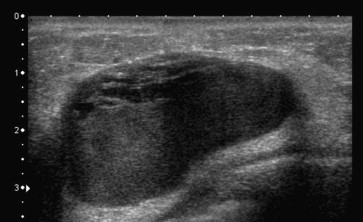 echoes breast with internal lesions