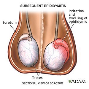 epididymitis anal sex