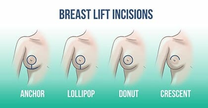 lift breast chicago