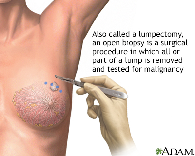 on biopsy lump breast