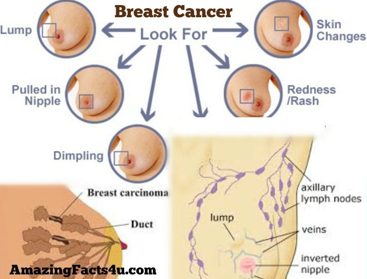 breast facts com