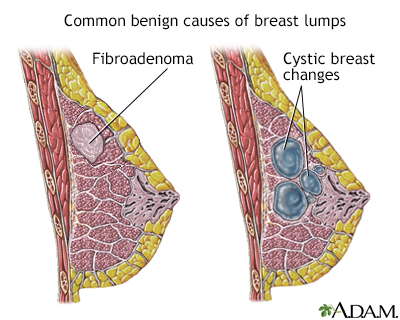 are lumpy breasts why